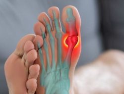 Cara Mengobati Asam Urat Pada Kaki Secara Alami Dan Cepat